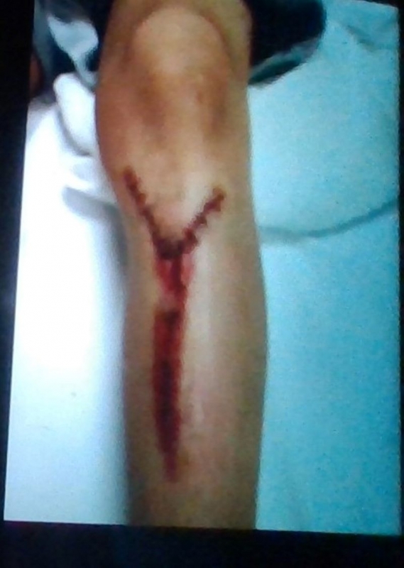 My leg after falling and getting 14 stiches. 